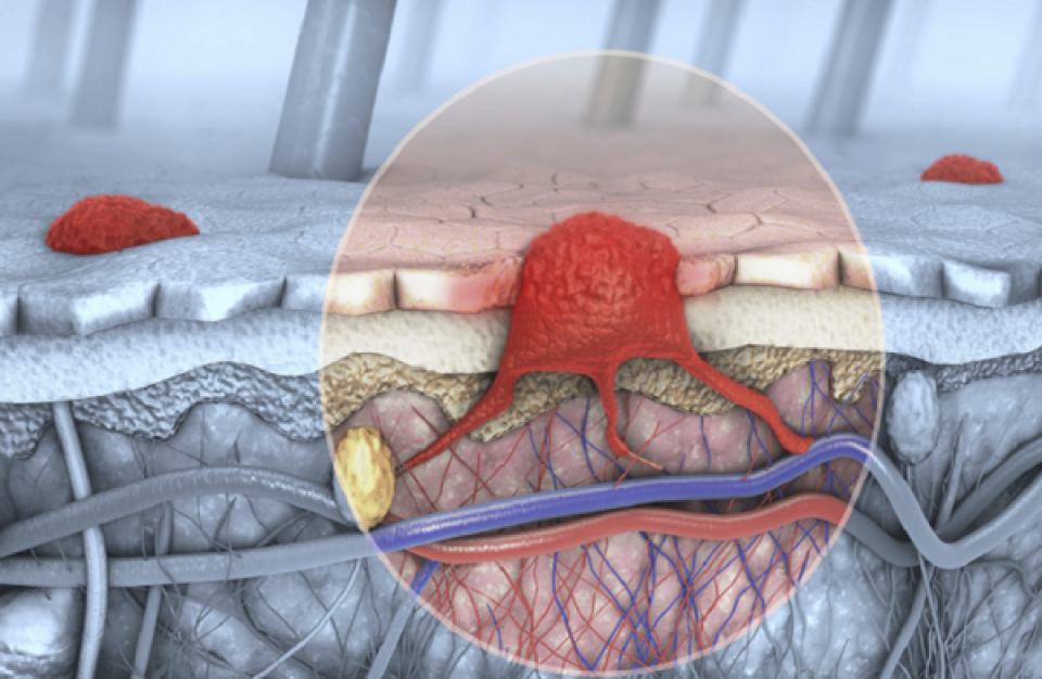 علماء روس يبتكرون هلاما لعلاج سرطان الجلد بفعالية مضاعفة
أفاد المكتب الإعلامي لجامعة تفير أن علماء الجامعة ابتكروا هلاما جديدا لعلاج سرطان الجلد، تتميز فعاليته بكونها أعلى بأربع مرات مقارنة بالمنتجات المستخدمة حاليا.
https://ar.rt.com/10snt